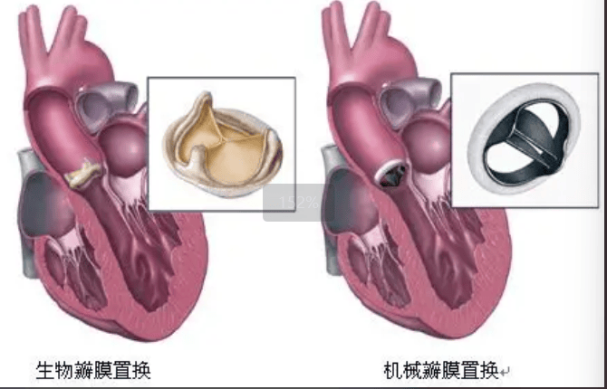 临汾市中心医院心脏大血管外科：心脏瓣膜出问题？别慌！教您读懂如何检查与治疗