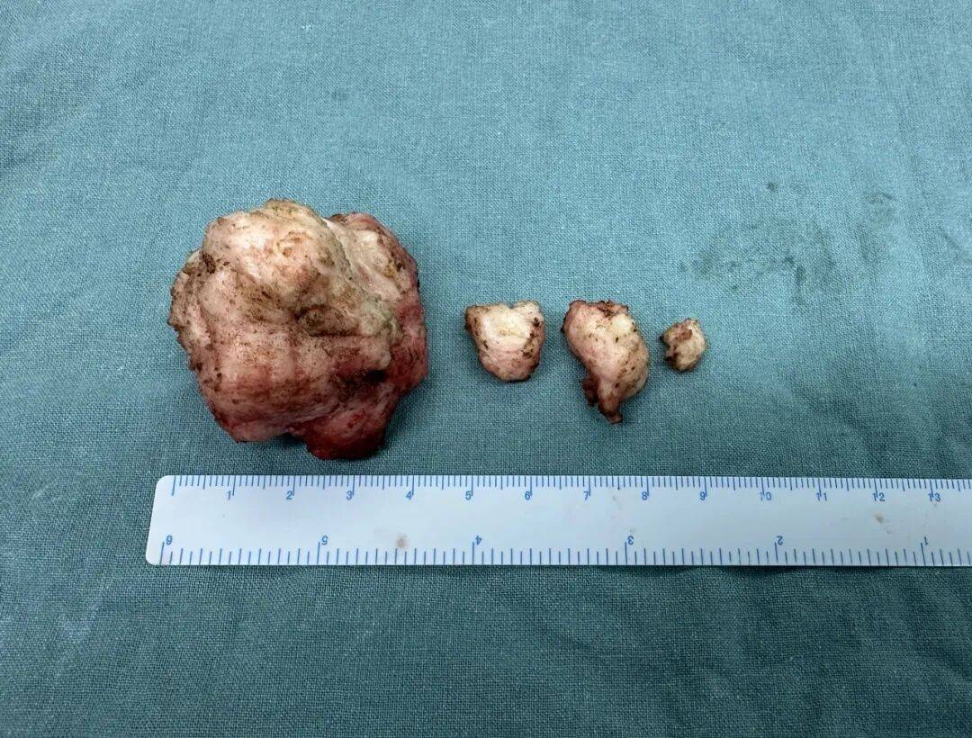 上海儿童医学中心成功为1岁婴儿切除巨大心脏纤维瘤