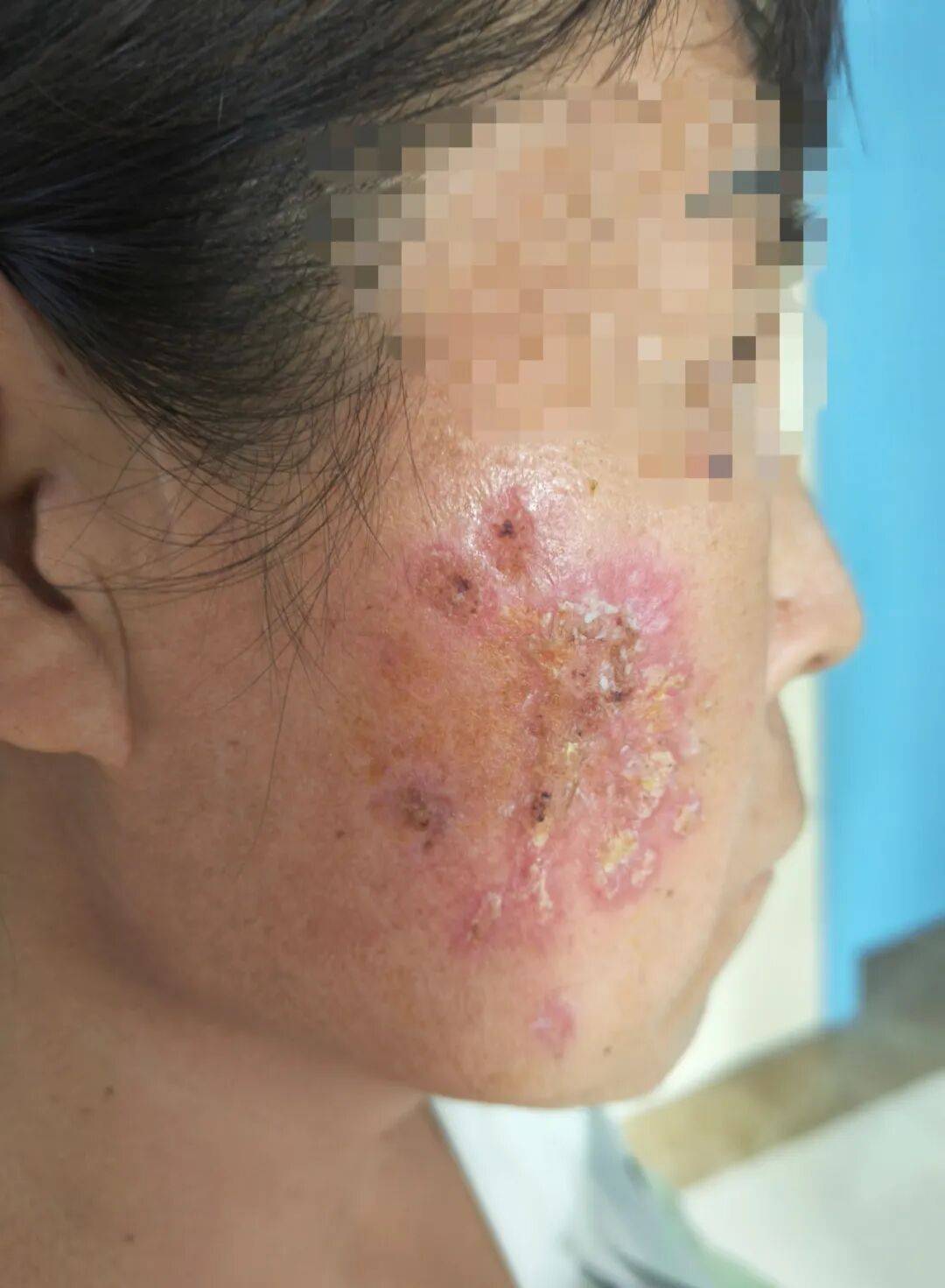 科室动态丨朝阳医疗区皮肤烧伤慢疮科攻克面部顽固性创面顽症