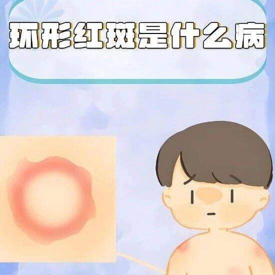 浑身长环形红圈是怎么回事？_皮肤_红斑_鳞屑