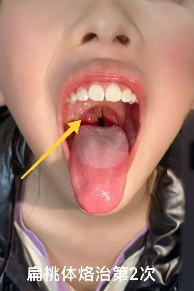 就扁桃体红肿化脓自己一遇换季,劳累