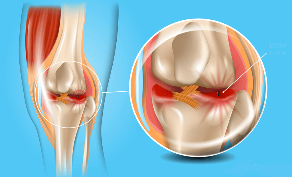 平时要预防半月板损伤