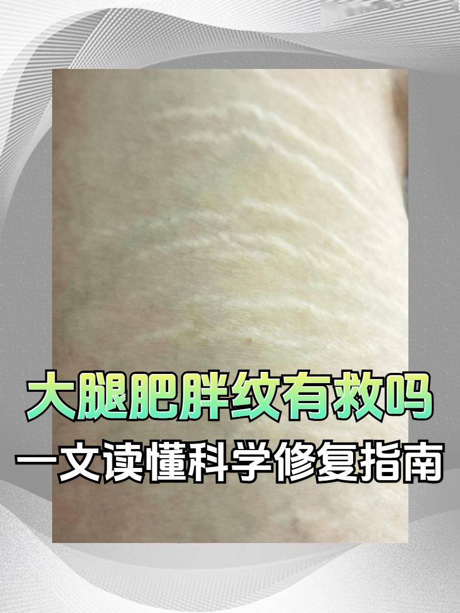 英国军队陷入"肥胖危机" 肥胖 皮肤问题 肥胖纹 治疗,四分之一士兵恐