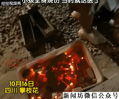 3岁男童掉进炭火堆全身85%烧伤