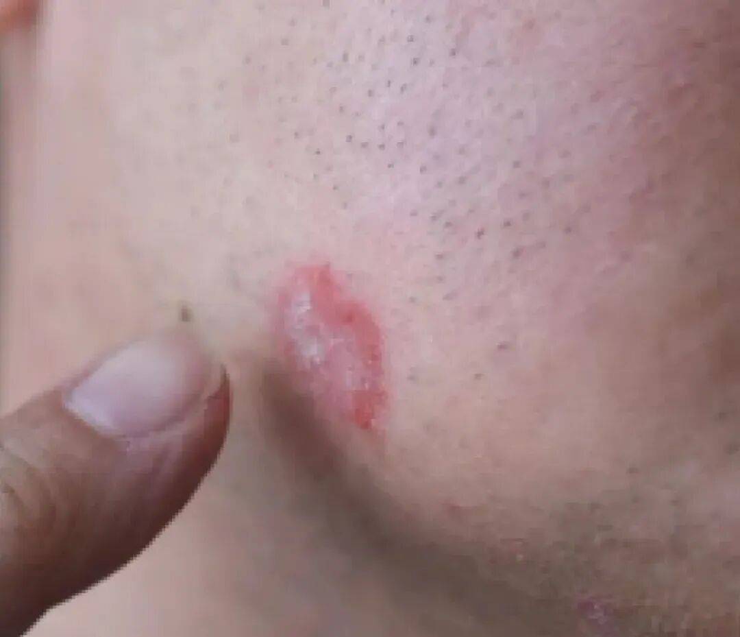 皮肤粗糙像长癣?先别乱涂药!真凶可能是这几种