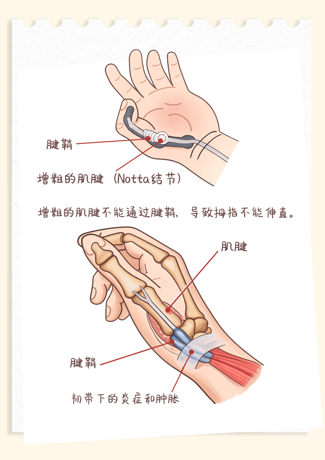 医聊| 手腕疼,胳膊酸