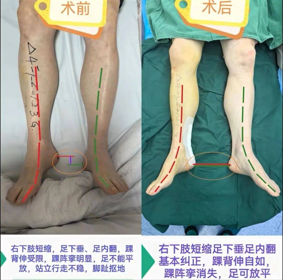 脑卒中后遗症合并肌张力增高患者重获康复希望!