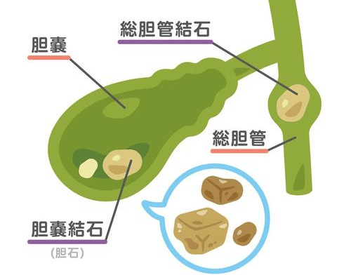 医生教你咋吃饭,告别胆管结石困扰_胆汁_饮食_胆囊