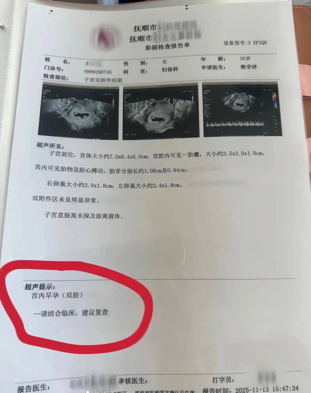辽宁一孕妇两个月内从一胎变四胞胎