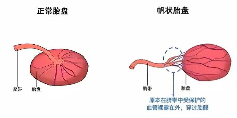 步步惊心!帆状胎盘合并前置血管_孙娟_孕产妇_女士