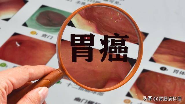 医生提醒：这14类人容易被胃癌盯上！