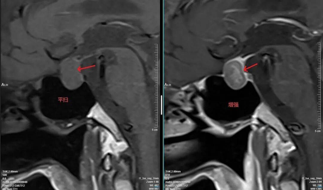突发头痛、视力下降？警惕脑垂体里的 “神秘住客”—垂体腺瘤