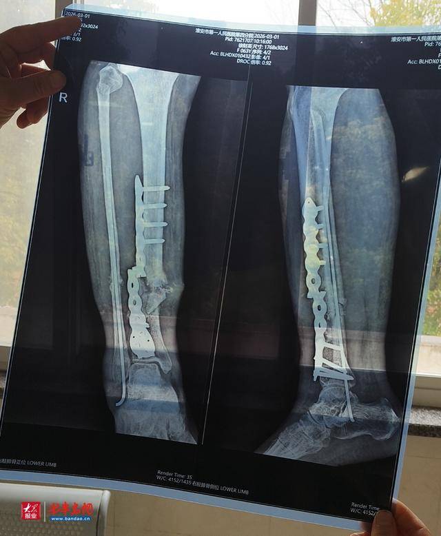 患者在沭阳铭和医院术后四月钢板断裂:院方称未遵医嘱所致(图1)