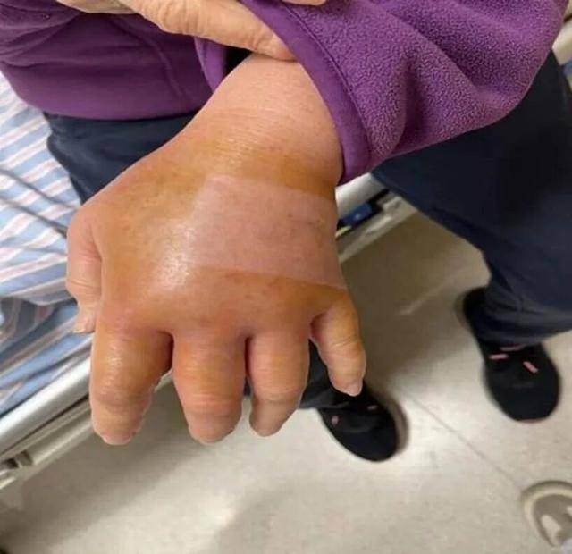 上海七旬阿姨被鱼刺扎手后，高烧39.7°C....