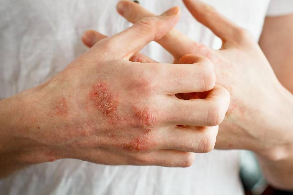 原创            越来越多的人患有湿疹！医生强调：家里久置的3种物品，或是原因