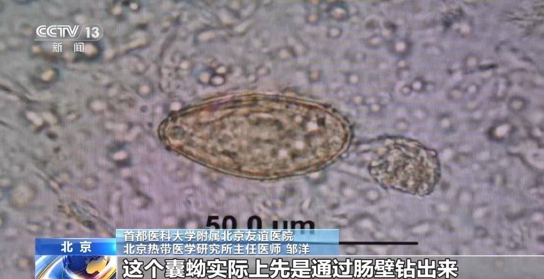 肝吸虫可致肝胆损伤诱发胆管癌，这类“鱼生”千万别碰